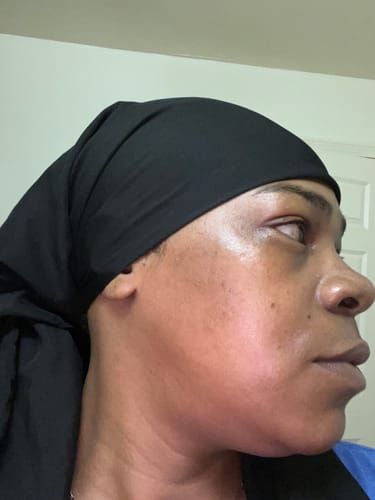 Reviewer's skin profile view showing the results of using Turmeric Brightening Soap for hyperpigmentation.