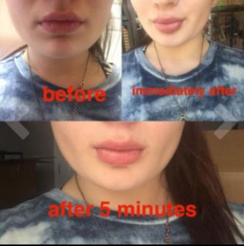 Customer photo review of Professional Lip Enhancing Pump