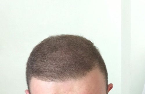 Customer photo review of Premium Hair Building Fibers