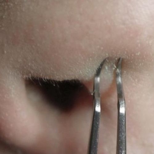 Blackhead Removal Tweezers