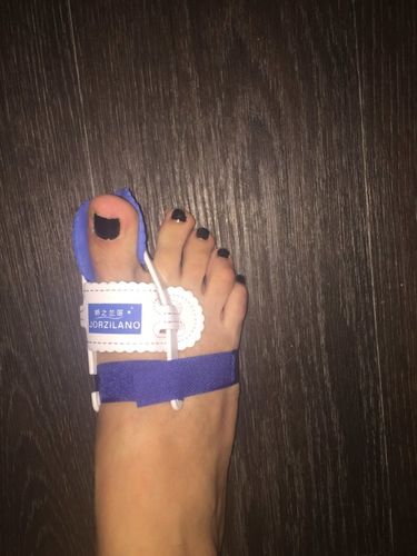 Customer photo review of Adjustable Orthopedic Bunion Corrector