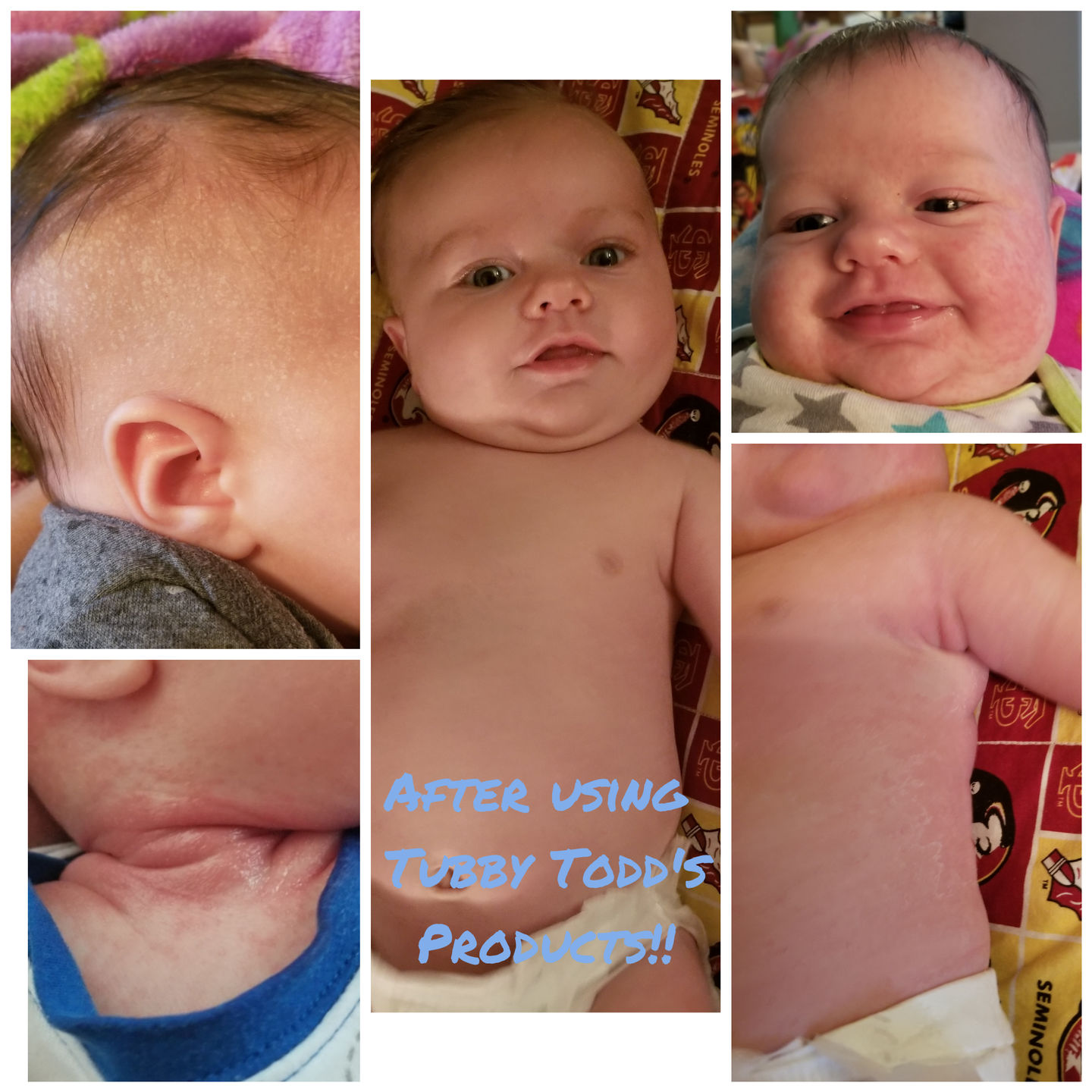 My month old baby had very bad cradle cap, baby acne, bad rash under