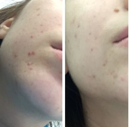 cosrx salicylic acid daily gentle cleanser before and after