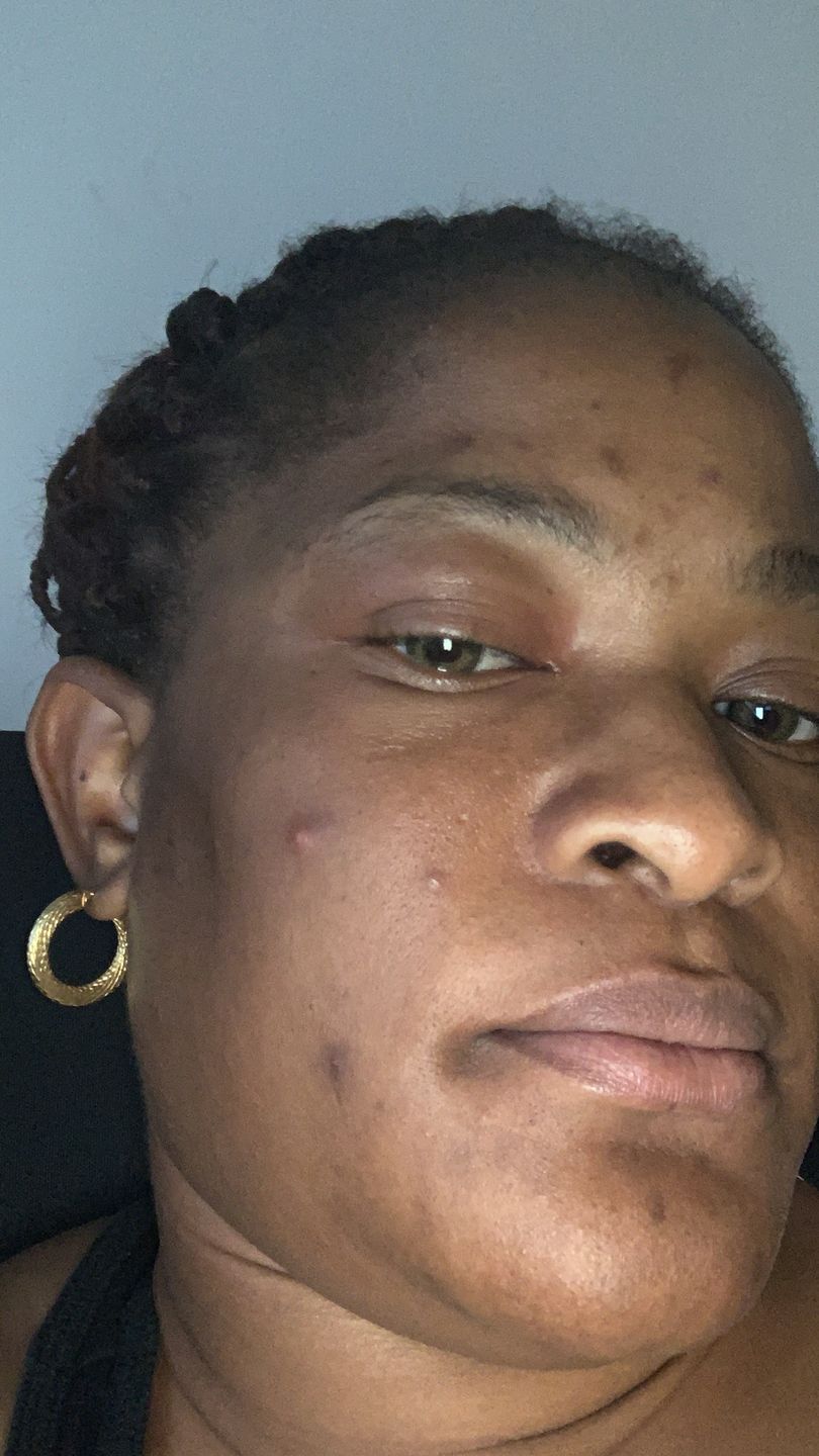 Customer photo review of Bolden Clear Skin Kit
