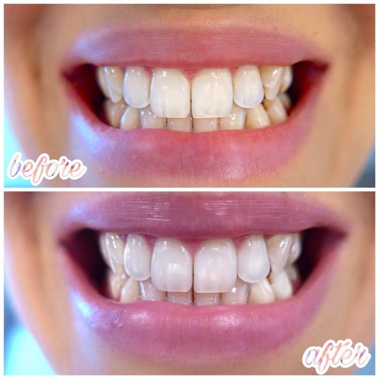 Customer photo review of Premium Zahnbleaching Set
