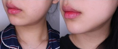 Customer photo review of YOUFE LED 紅光儀 (近紅外版) NR1