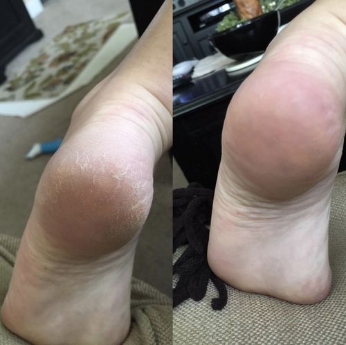 CALUVER™: Electric Callus Remover CALUVER™: Electric Callus Remover