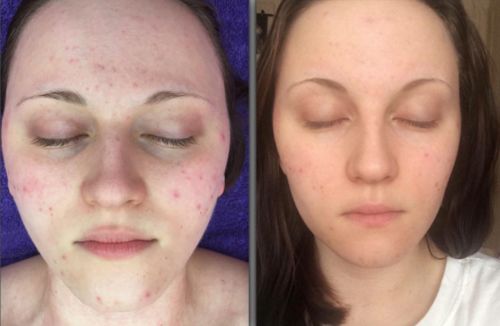 ordinary niacinamide acne