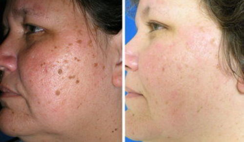 Amanda L. review of Skin Spots Removal Pen