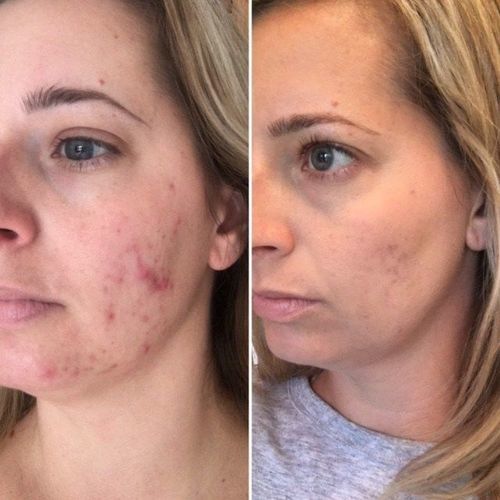 Lucy A. review of Skin Spots Removal Pen