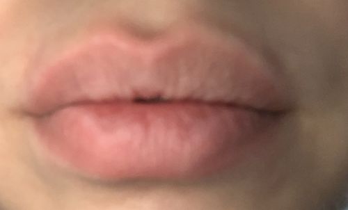 Customer photo review of LIP BOOSTING SYSTEM