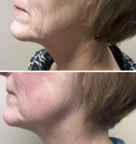 rejuve bella before and after