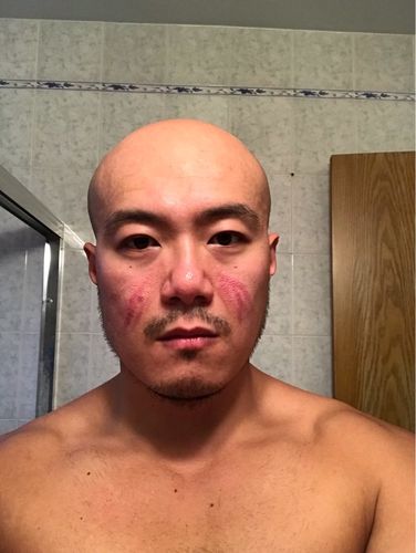 Customer photo review of Vacuum Blackhead Remover