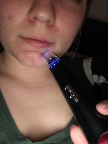 Customer photo review of Vacuum Blackhead Remover