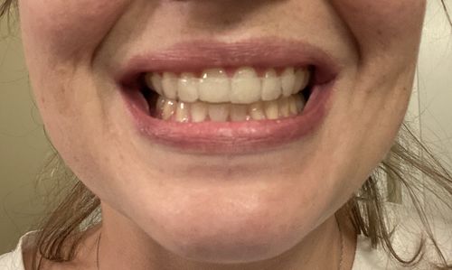 Customer photo review of Night Guard Auto renew