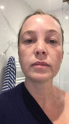 Customer photo review of Anti-Wrinkle Patches for Face Lift