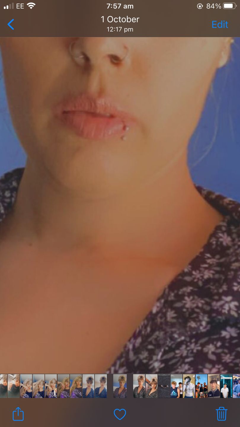 Customer photo review of NeilMed Sterile Saline Piercing Aftercare
