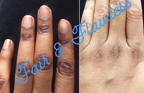 Customer photo review of POWERFUL® Dark Knuckle Corrector