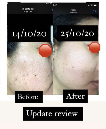 Customer photo review of Niacid