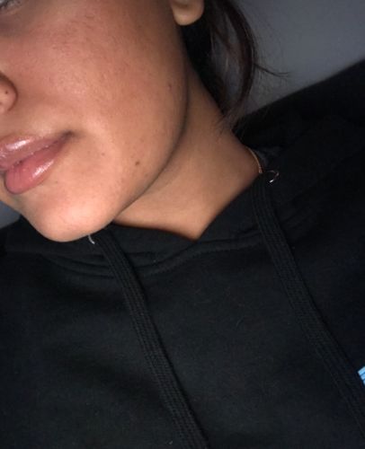 Customer photo review of Skin Fix: Microneedling