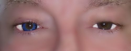 Customer photo review of Mystery Blue Prescription Contact Lenses