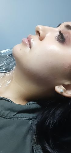 Customer photo review of MesoLipo Serum