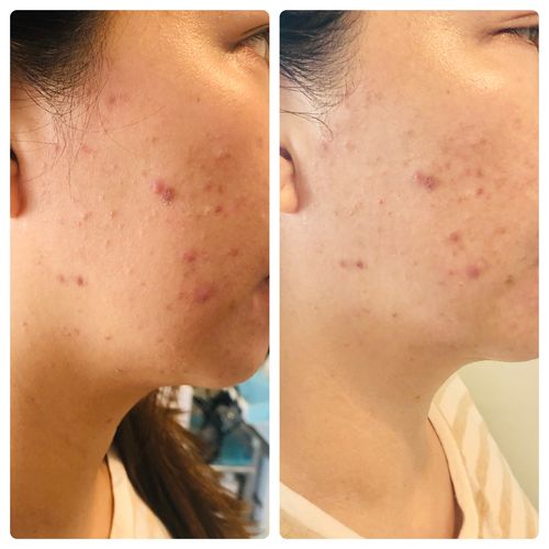 Customer photo review of MesoBlemish Serum