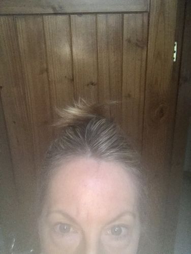 Customer photo review of Anti-Wrinkle Patches for Face Lift