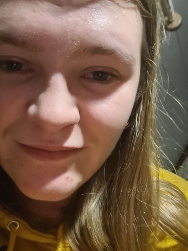 Customer photo review of SkinGlow Electric Cleanser - No More Blackheads
