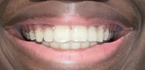 Customer photo review of Invisible Aligners