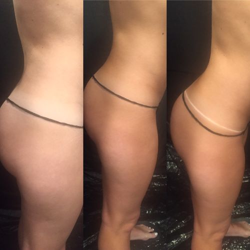 Customer photo review of Illumin8 Dry Oil Express Spray Tan Solution - 1L