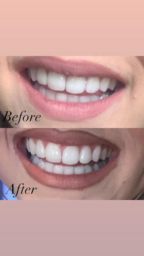 Customer photo review of Whites Non-Peroxide Teeth Whitening Kit
