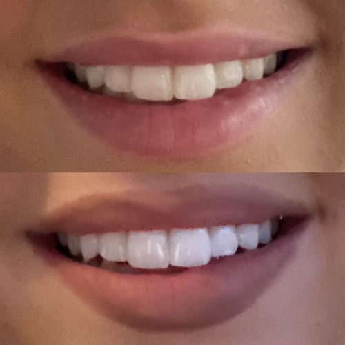 Customer photo review of Whites Non-Peroxide Teeth Whitening Kit