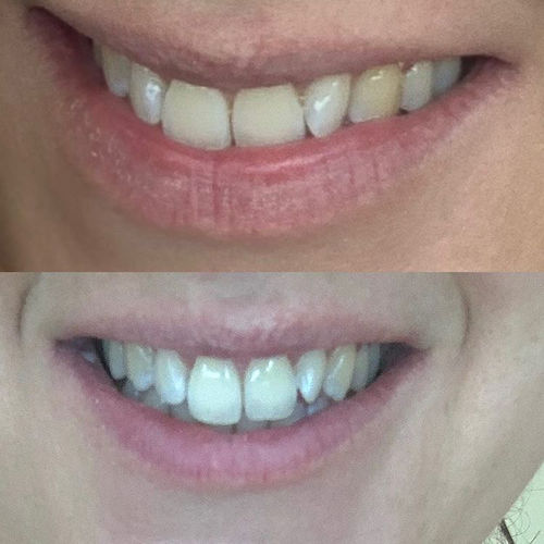 Customer photo review of Whites Non-Peroxide Teeth Whitening Kit