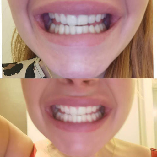Teeth Whitening Foam
