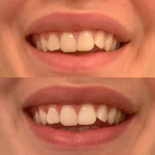 Customer photo review of Whites Teeth Whitening Strips