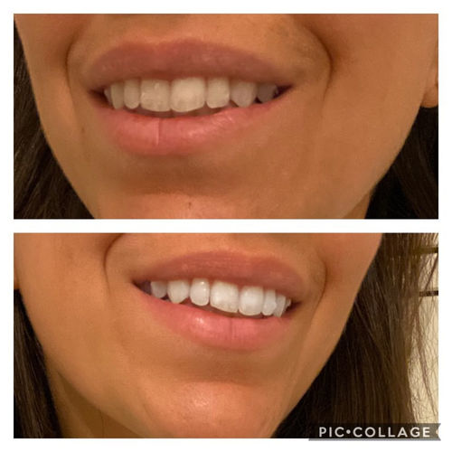 Customer photo review of Whites Non-Peroxide Teeth Whitening Kit