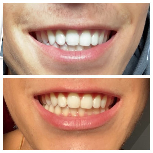 Customer photo review of Whites Non-Peroxide Teeth Whitening Kit