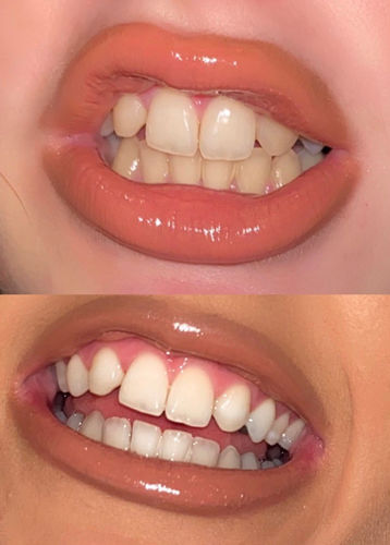 Customer photo review of Whites Teeth Whitening Strips