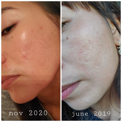 Customer photo review of Niacid