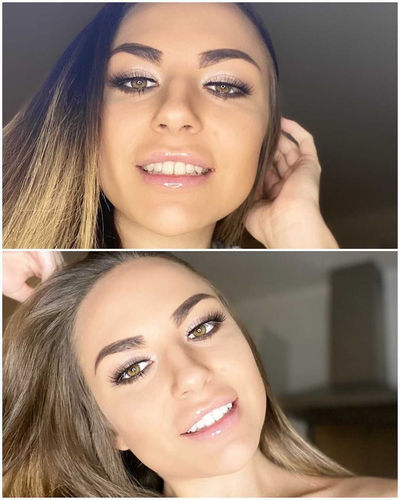 Customer photo review of Whites Non-Peroxide Teeth Whitening Kit