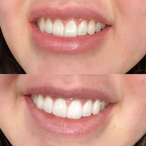 Customer photo review of Whites Coconut Oil Pulling Sachets