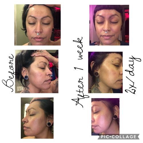 Customer photo review of BERRI-CLEAR+ 5 BERRY SUPERFRUIT SERUM