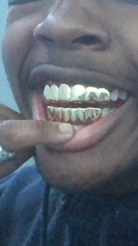 Customer photo review of Gold Polished Shiny Teeth Grill Combo by Best Grillz