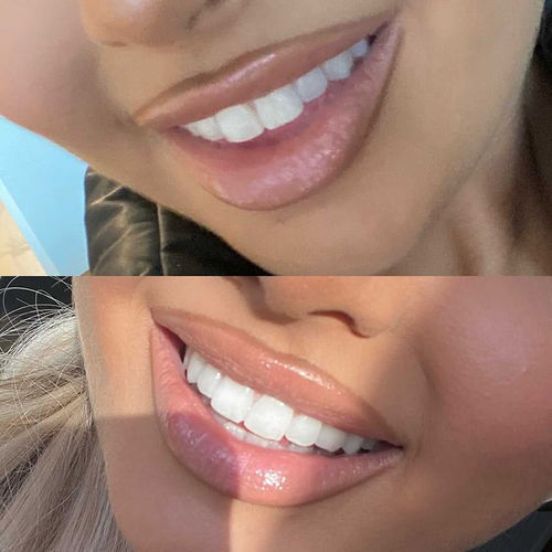 Teeth Whitening Foam