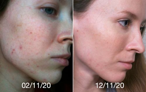 Customer photo review of Ziegenmilch Bio-Masken-Seife TEINT PRÉCIEUX von MaggyBeauty