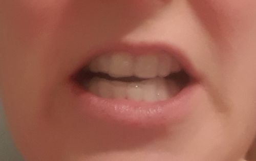 Customer photo review of SleepPro Teeth Whitening - Custom Made Bleaching Trays