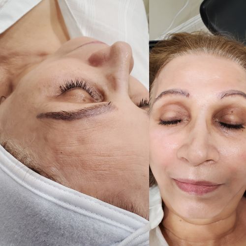 Customer photo review of ScalpaJect Hyaluronic Acid Powder