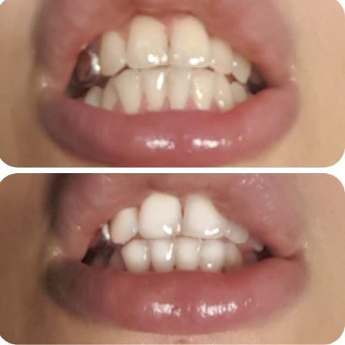 Customer photo review of Whites Non-Peroxide Teeth Whitening Kit