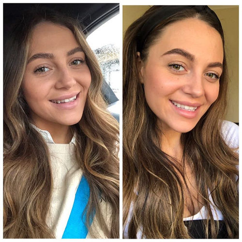 Customer photo review of Whites Non-Peroxide Teeth Whitening Kit